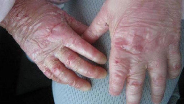 Imagen de archivo de unas manos con el síndrome de piel de mariposa