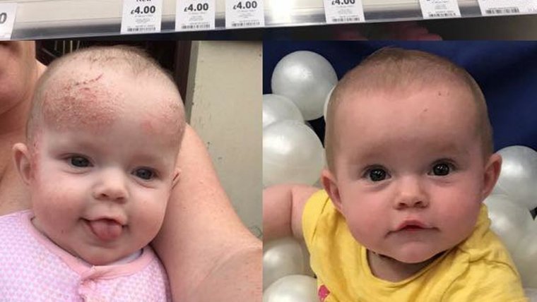 El antes y el después de los eczemas de una bebé tras utilizar la crema.