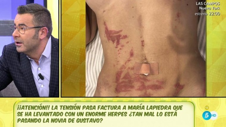 Una de las imágenes del supuesto herpes de María Lapiedra