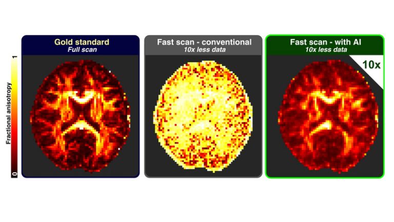 Una nova estratègia d’IA aconseguix acurtar fins a un 90% les ressonàncies cerebrals avançades